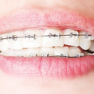 Dental Anja Kastav Rijeka Fiume Ortodoncija